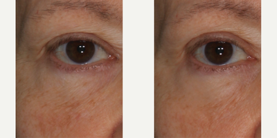 Skinbetter Science - InterFuse Intensive Treatment Cream Eye.Photo provided courtesy of Skinbetter Science.