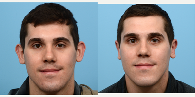 25-34 year old man treated with Ear Surgery - 28-year-old patient had an otoplasty with Dr. Wise. 2 months post-op he is very happy with the results!