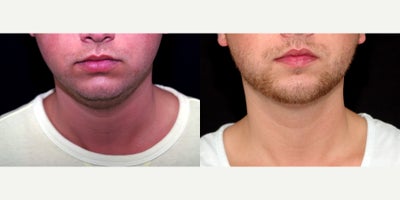 26 year old man treated with PrecisionTx - 26 year old man treated with PrecisionTx. Photo depict before and 4 months after surgery.