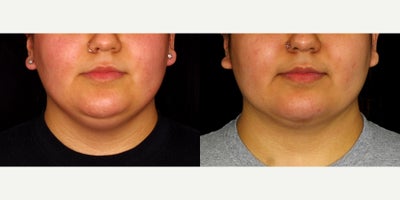 20 year old woman treated with PrecisionTx. - 20 year old woman treated with PrecisionTx. Photos depict before and 1 month after surgery.