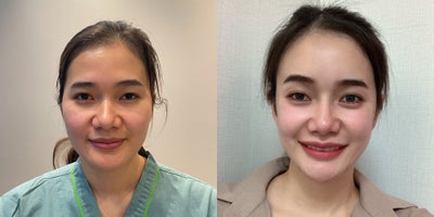 25-34 year old woman treated with Cheekbone Reduction, Facial Fat Transfer - Cheekbone ReductionFat Grafting to the face
