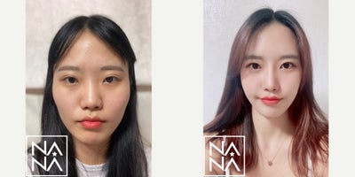 25-34 year old woman treated with Cheekbone Reduction, Facial Fat Transfer, Asian Rhinoplasty, Double Eyelid Surgery - Cheekbone Reduction SurgeryFull Face Fat GraftingRhinoplasty Non-incisional Double Eyelid Surgery