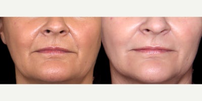 47 year old woman treated with Restylane Refyne - 47 year old woman treated with Restylane Refyne. Photos depict before and 1 month after surgery.