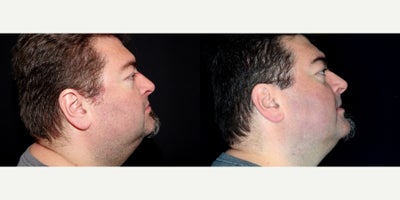 52 year old man treated with IPL - 52 year old man treated with IPL for Rosacea