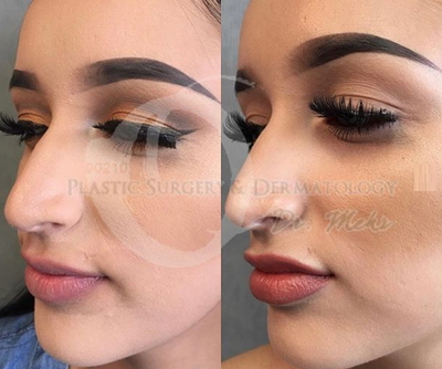 Woman treated with Injectable Fillers - Woman treated with Injectable Fillers