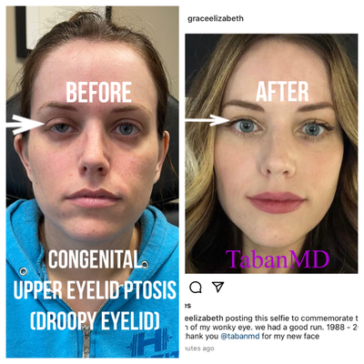 scarless eyelid ptosis repair - Young woman, with congenital droopy right upper eyelid (ptosis) underwent right scarless ptosis repair. Before and after selfie photo are shown.