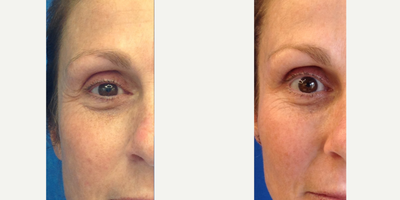 35-44 year old woman treated with Xeomin - Lateral brow lift with Xeomin, before and 1-monht post injection. Also correcting crow's feet.