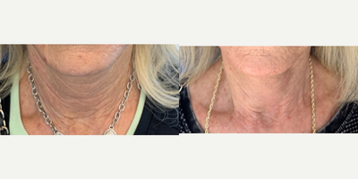55-64 year old woman treated with Nonsurgical Neck Lift - Filler to neck to decrease appearance of neck lines