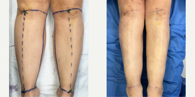 45-54 year old woman treated with Lipedema Surgery, Liposuction - Immediate on the table post-op results from circumferential Lipedema Liposuction on this Stage 2 patient's calves and ankles.