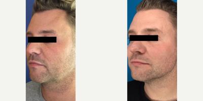 25-34 year old man treated with Aqualyx - This gentleman couldnt shift the weight from his under chin area with his diet and exercise.I treated him with 2 sessions of Aqualyx.