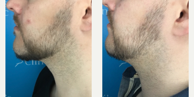 25-34 year old man treated with Aqualyx - Just 1 session of Aqualyx.