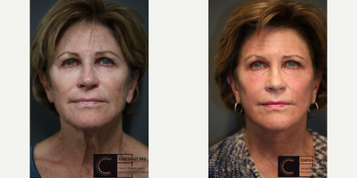 Minimally invasive lift - Neck and facelift performed with local anesthesia and the most modern techniques.