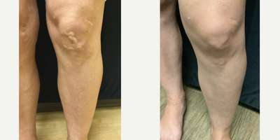 Sclerotherapy and RFA - Pre vs Post treatment of sclerotherapy & vein ablation