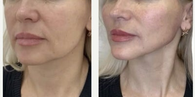 45-54 year old woman treated with Dermal Fillers, Botox, Micro Botox, Lip Fillers - Sculptra and Dermal Filler placements with Aubrey Houchin