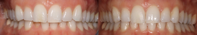 25-34 year old woman treated with Clear Braces - Invisalign and dental bonding