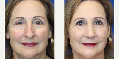 Woman treated with Rhinoplasty - Rhinoplasty