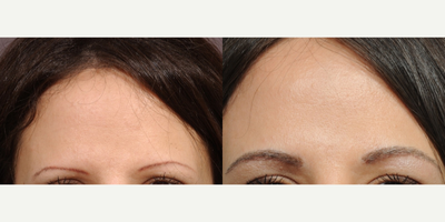 37 year old woman - FUT eyebrow transplant