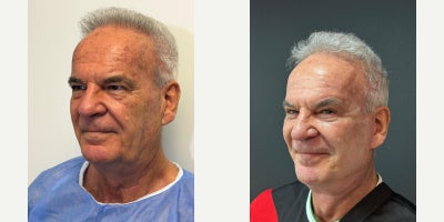 65-74 year old man treated with Facelift - Deep plane face and neck liftBrow liftFat transferUpper and lower BlephoraplastyTemporal lift
