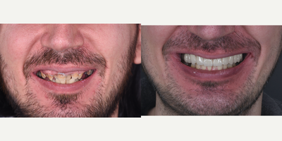 25-34 year old man treated with Dental Bone Graft, Dental Implants, Smile Makeover - Our patient had hopeless teeth in his upper jaw. Also high smile line was present which made the case difficult to achieve a good aesthetics. After digital analysis by the use of 3D CT, bone reduction, extraction of all hopeless teeth and placement of 8 implants was planned. After a 3 months of period, permanent fixed prosthesis has been delivered.