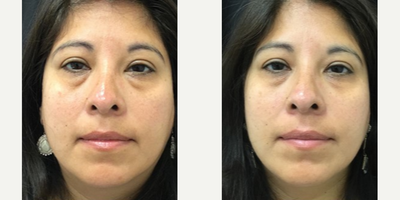 Woman treated with TempSure Envi - Woman treated with TempSure Envi to under eyes to get rid of puffiness and dark circles, shown 2 months post op.