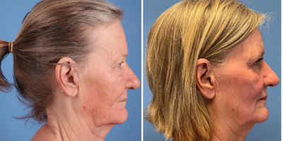 65 year old woman treated with Phenol Peel - Dr.Sukkar performed a Phenol Peel on this 65 year old patient. Post-op photos taken at 3 months post procedure.The Clinic For Plastic Surgery14018 Aesthetic CircleHouston, TX 77062(281)990-8487www.drsukkar.com