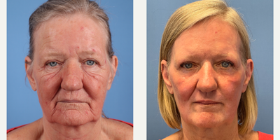 65 year old woman treated with Phenol Peel - Dr.Sukkar performed a Phenol Peel on this 65 year old patient. Post-op photos taken at 3 months post procedure.The Clinic For Plastic Surgery14018 Aesthetic CircleHouston, TX 77062(281)990-8487www.drsukkar.com
