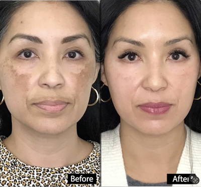 Woman treated with Coolaser, Skin Lightening - Treatment: Coolaser & Bluelight Skin Lightening (single session)Purpose: To treat melasma, skin discoloration, sun damage, and sunspotsHow it works: Using Bluelight and CoolaserResults: Will be seen in a few days to weeksNote: Individual results may varyTechnique: Coolaser and/or Bluelight dual treatmentAnesthesia: Topical onlyTime it takes: 30 minutes to 60 minutesRecovery: 1-7 daysLasts: Semi-PermanentCaution: Must be performed by an experienced providerPain level: Varies Mild to moderateNumber of sessions recommended: 1-3