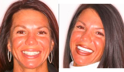 Porcelain veneers - After Invisalign to improve her bite and allow minimal preparations, DURAthin porcelain veneers were placed on her upper teeth.