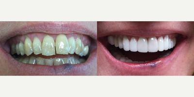 45-54 year old woman treated with Porcelain Veneers - <p>Patient presented with severe tetracycline staining, present since childhood. After 2 appointments and 25 porcelain units, patient has a totally different smile and totally new look. No longer does teeth staining block her true beauty. Her teeth look natural and flawless. No more hiding from photos.</p>