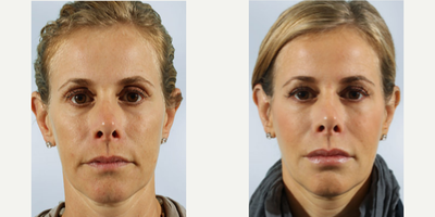 42 year old woman treated with Sculptra Aesthetic - 42 year old woman treated with 8 vials of Sculptra Aesthetic, shown 5 months post op.