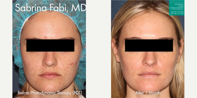 18-24 year old woman treated with Photodynamic Therapy - Photodynamic therapy used to treat acne on a female patient by Dr. Fabi.