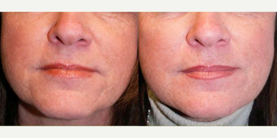 Woman treated with Juvederm - Juvederm