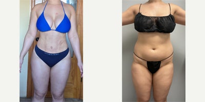 Woman treated with Rib Remodeling - Woman treated with Rib Remodeling