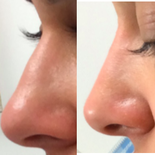 Restylane Lyft to nose to smooth hump - This woman wanted a straighter, more refined nose profile. Dr. Kotlus performed Restylane Lyft because it is one of the stiffest fillers with arguably improved safety over Voluma and Radiesse.
