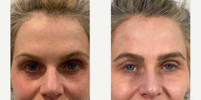 45-54 year old woman treated with ProFractional Laser - ProFractional laser performed on the eye area at 8 West Clinic, Vancouver, BC