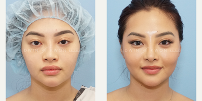 18-24 year old woman treated with Asian Rhinoplasty, DCF Rhinoplasty, Lower Bleph, Fat Transfer Cheeks (5 Mo. Update) - 18-24-year-old woman treated with DCF rhinoplasty. Patient had been utilizing filler to her nose for several years. Patient was seeking to have a more permanent change. Preoperative photos still show filler in her nose which was removed intraoperatively with a combination of direct removal as well as hyaluronidase. Her nasal bridge had become much flatter and thus needed reestablishment of height with a DCF graft. The nasal tip was refined with a combination of soft tissue debulking, cephalic trim, and increased tip projection. A nasal cap graft created from the ear cartilage was placed on the tip to soften the tip appearance as the patient wanted to have a more button nose tip. Patient had significant asymmetry in the nasal side walls, thus requiring unilateral osteotomy.2nd surgery: Patient returned and was treated with lower blepharoplasty and fat transfer to cheeks.  Patient has lower lid fat herniation despite her young age. The lower lid was partially removed and the remaining fat repositioned. The flat mid-face was addressed with fat transfer to the anterior cheeks to help bring more dimension to her face.