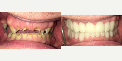 45-54 year old man treated with Snap-On Smile - 53 year old male presents with severely eroded upper and lower anterior (front) teeth with several missing posterior (back) teeth. Patient has no teeth sensitivity or teeth decay. He wanted an affordable way to improve his smile and ability to chew without extractions or implants. The Snap On Smile is a non-invasive and completely reversible, cosmetic removable arch that can easily and painlessly give you a beautiful smile. It can function as a partial denture to replace missing teeth without the bulkiness of a traditional removable partial denture. Getting a Snap-On Smile simply requires two, short, painless visits with usually no drilling, no shots and no change in tooth structure (significantly bulky,poorly placed or exceptionally prominent teeth may need adjustment). You can wear it all day and eat with it.