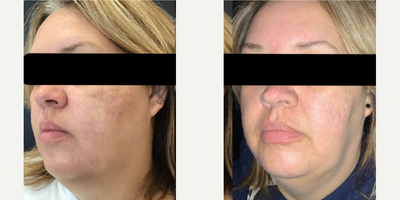 45-54 year old woman treated with Skin Rejuvenation, ResurFX, Microneedling - This client started her treatment plan with a series of ResurFX followed up with microneedling with FDA approved Skin Pen to vastly improve acne scarring.