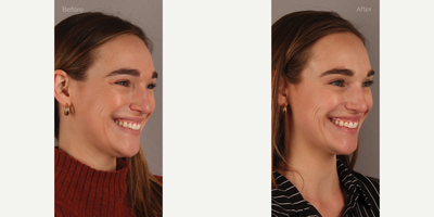 Upper Facial Botox (Forehead, 11's, Crows Feet) - 29-year-old female who requested conservative Botox treatment to address upper facial wrinkles of expression. Conservative dosing was used to preserve facial movement but reduce wrinkling. She is shown two weeks post-treatment.