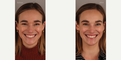 Upper Facial Botox (Forehead, 11's, Crows Feet) - 29-year-old female who requested conservative Botox treatment to address upper facial wrinkles of expression. Conservative dosing was used to preserve facial movement but reduce wrinkling. She is shown two weeks post-treatment.