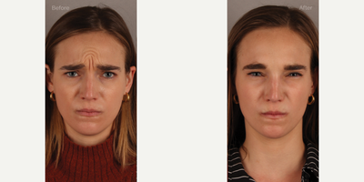 Upper Facial Botox (Forehead, 11's, Crows Feet) - 29-year-old female who requested conservative Botox treatment to address upper facial wrinkles of expression. Conservative dosing was used to preserve facial movement but reduce wrinkling. She is shown two weeks post-treatment.