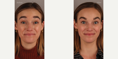 Upper Facial Botox (Forehead, 11's, Crows Feet) - 29-year-old female who requested conservative Botox treatment to address upper facial wrinkles of expression. Conservative dosing was used to preserve facial movement but reduce wrinkling. She is shown two weeks post-treatment.