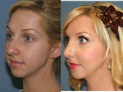 Woman treated with Rhinoplasty - Woman treated with Rhinoplasty