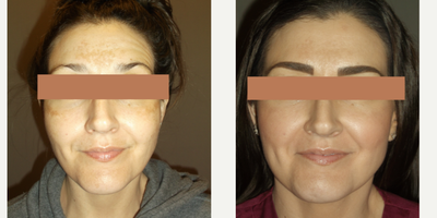 35-44 year old woman treated with PicoSure - Patient treated for dark pigmentation and old acne spots.