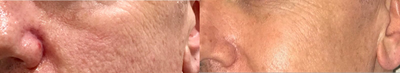 45-54 year old man treated with multiple modalities - Just Ageless skin smoothing package