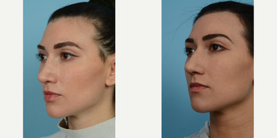 25-34 year old woman treated with Revision Rhinoplasty - 31-year-old revision rhinoplasty patient, 3 months post op