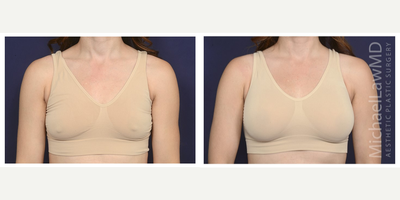35-44 year old woman treated with Mentor Breast Implants - Breast augmentation. Follow-up photo taken 3 months after the procedure.