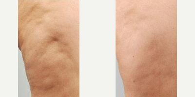 Woman treated with Cellulaze - Woman treated with Cellulaze
