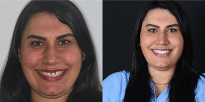 35-44 year old woman treated with Dental Crown, Smile Makeover, Lumineers, Dental Bridge, Porcelain Veneers - Our patient had gaps between her upper teeth and she was unhappy for this reason.We performed a digital smile design and deliveres E-max crowns. The final result is very satisfactory.