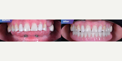 35-44 year old woman treated with All-on-4 Dental Implants - Bottom Acrylic all-on-4